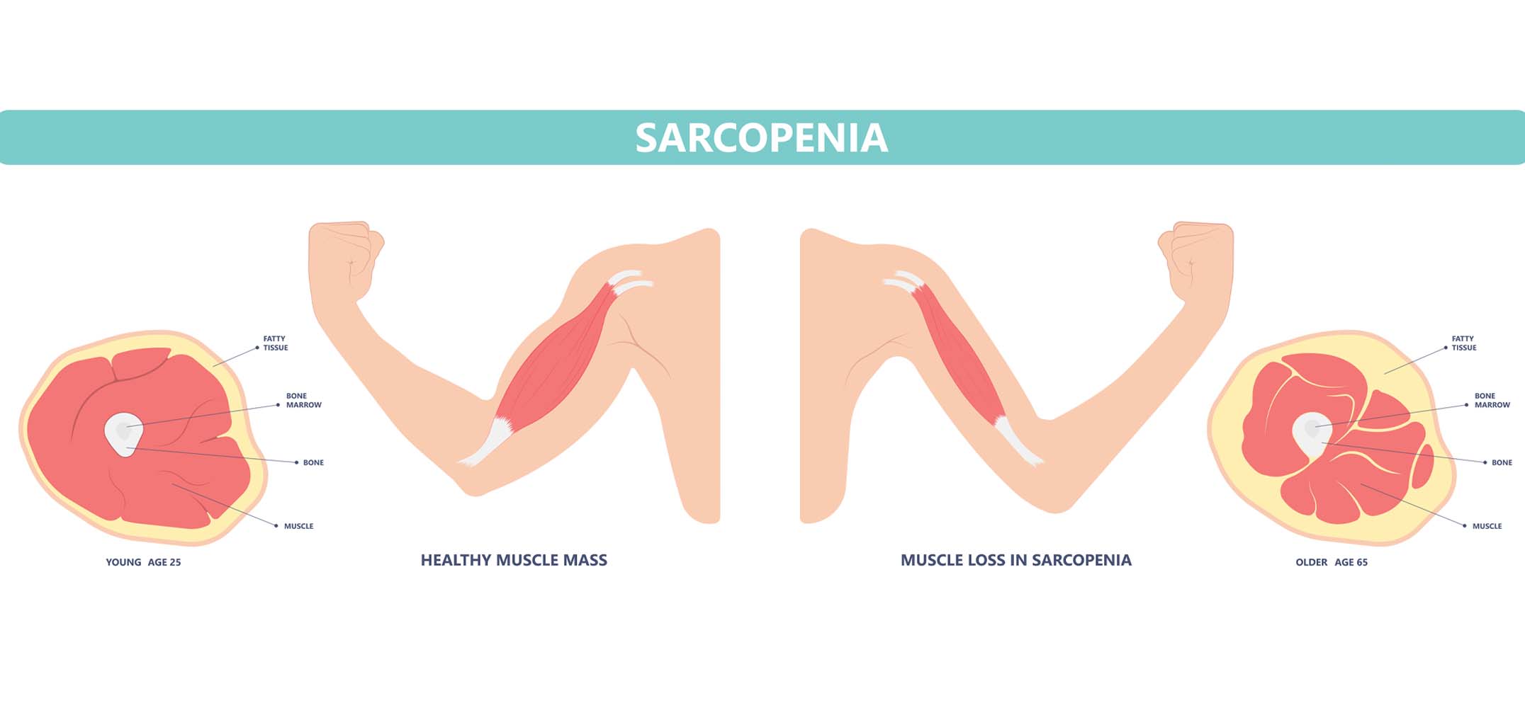Sarcopenia