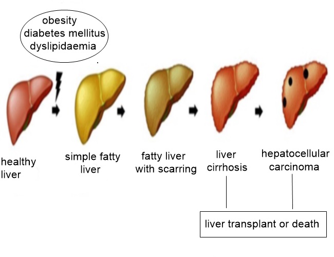 Non-alcoholic Fatty Liver Disease (NAFLD) and your Thyroid - Sally-Ann ...