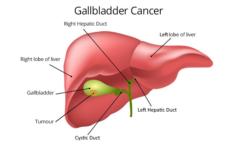 Gallbladder Disease