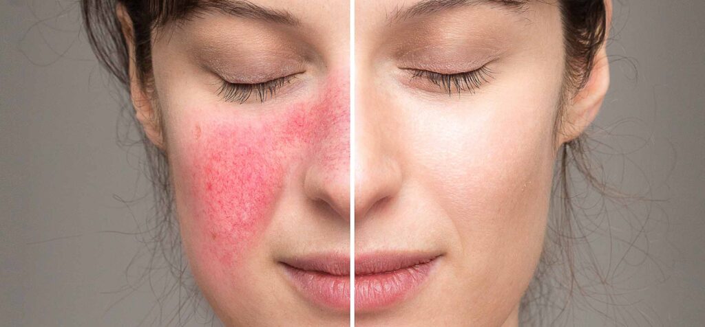 Do you suffer from rosacea?