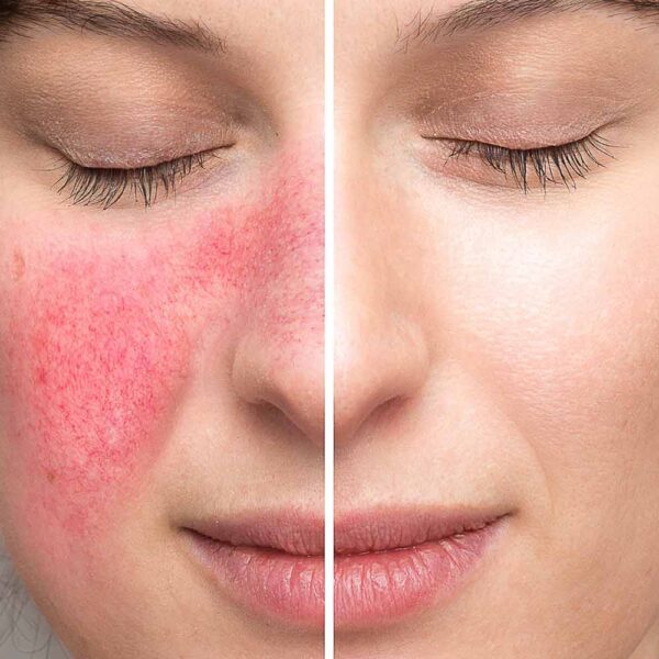 Do you suffer from rosacea?