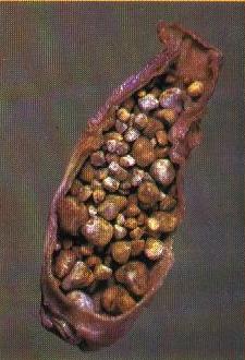 Gallstones in Weight Loss