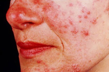 Rosacea